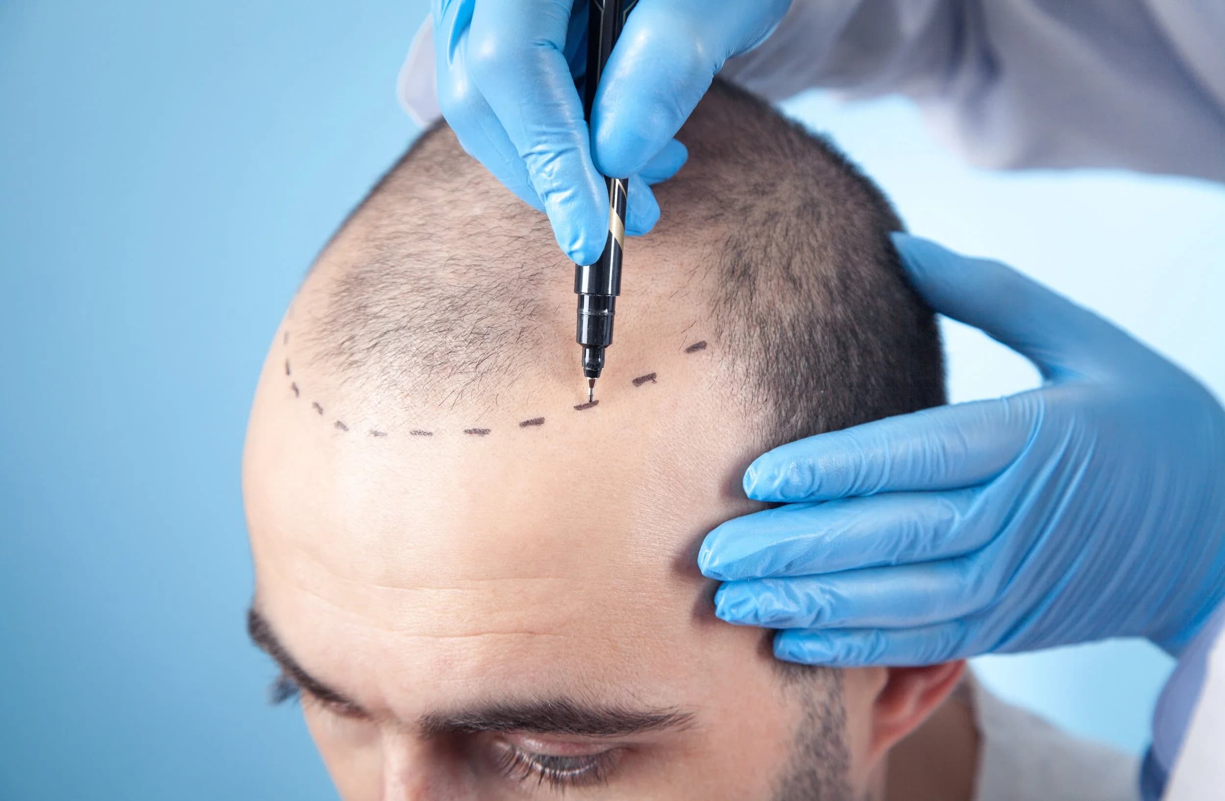 Doctor-led FUE hair transplant at Calyx Skin Lab